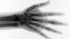 X-ray of hand