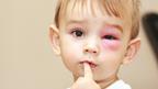 Child with swollen pink eye
