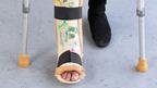 Womans leg in plaster