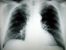 Pulmonary embolism