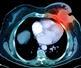 Almost 1,000 deaths from advanced breast cancer would be prevented each year if England's survival rates matched those in Norway and Sweden, research has shown.