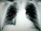 Chest Xray radiology example