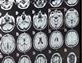 Stroke care gets better since health check