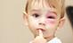 Child with swollen pink eye