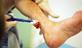 Ulcer on ankle