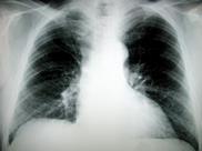 Change Forecast - X-ray chest radiology